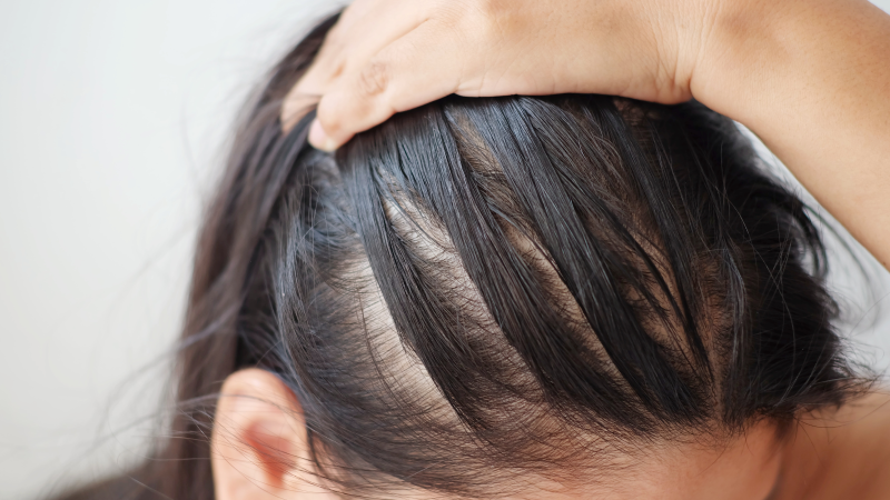 Female Pattern Baldness  Causes  Treatments