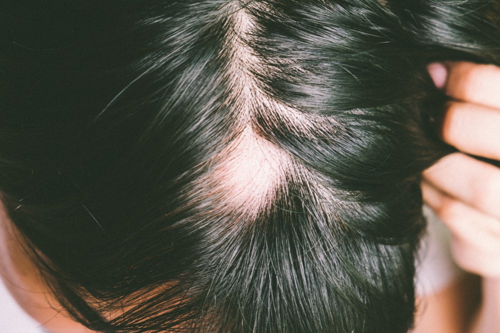 Understanding Alopecia Areata (Hair Loss) & Treatments